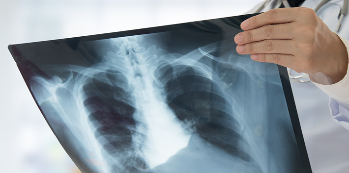 Monitoring und Progressionskriterien einer ILD