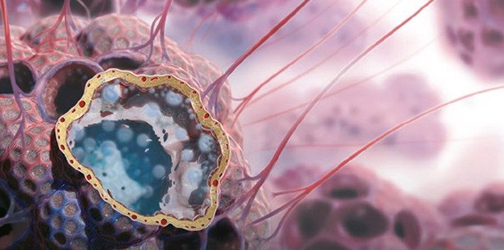 IPF Pathogenese Verlauf