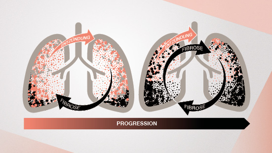 Autoimmunbedingte ILDs: die Lunge im Blick behalten