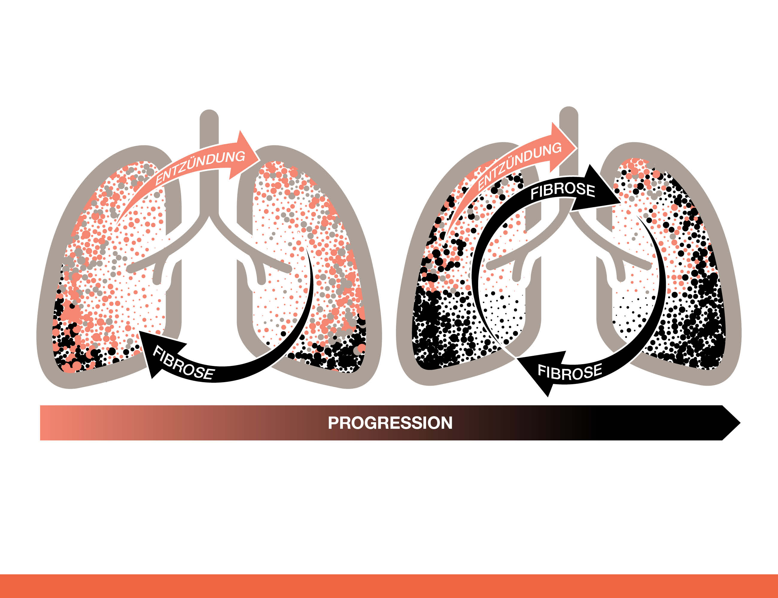 Fibrose braucht Antifibrose