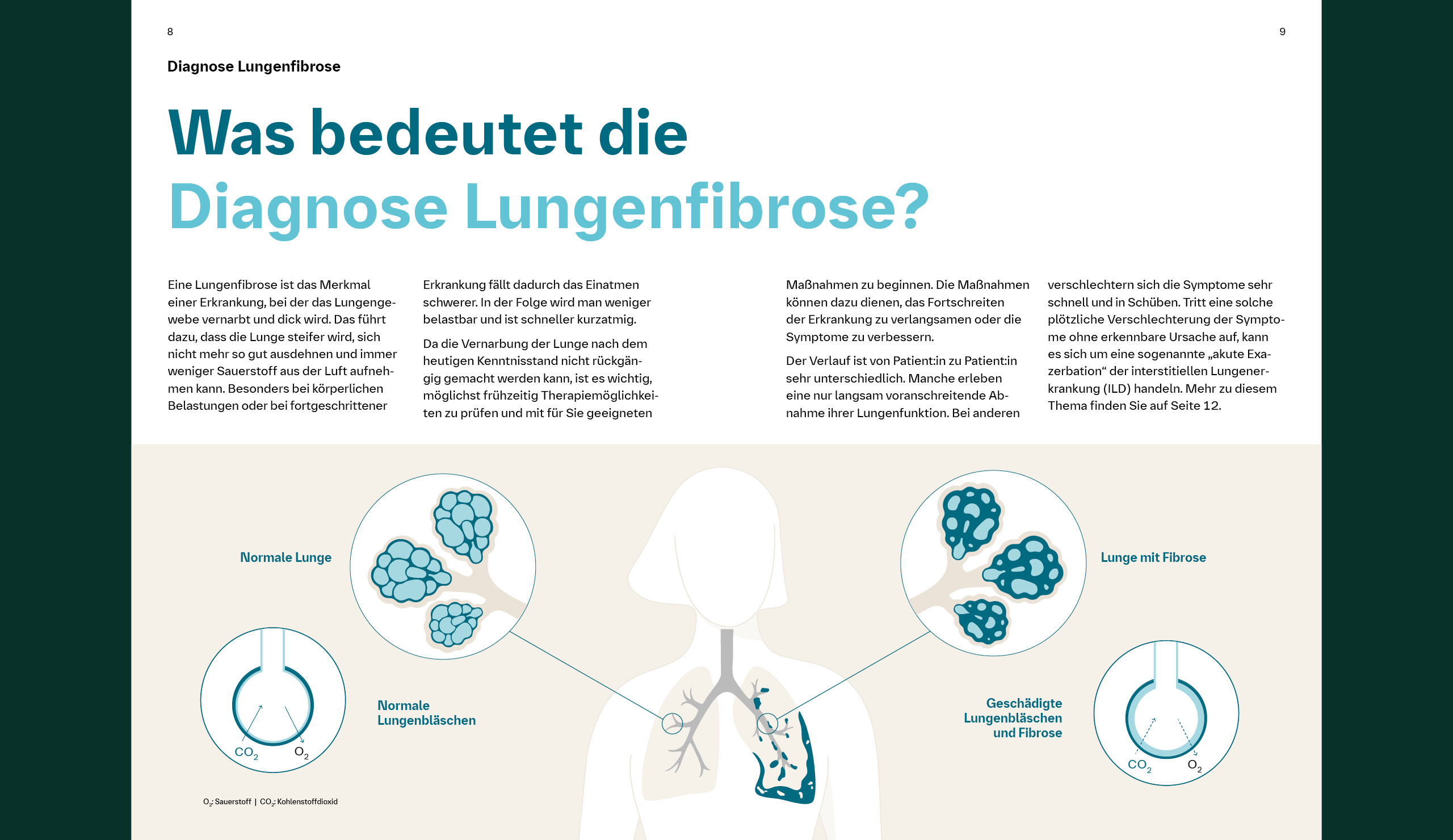 Was bedeuted die Diagnose Lungenfibrose?