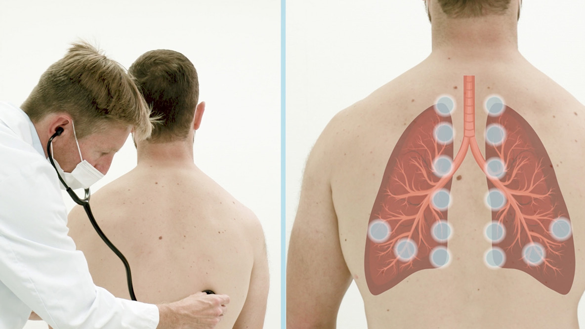 Auskultation der Lunge: Arzt hört Patienten ab, ergänzt durch eine schematische Darstellung der Auskultationspunkte.