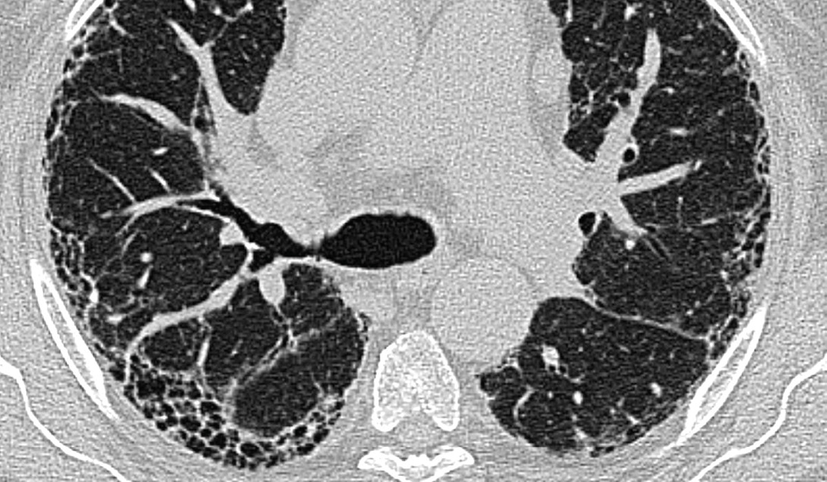 HRCT-Aufnahme, idiopathische Lungenfibrose